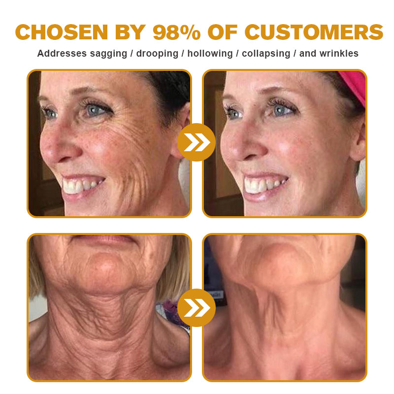 (✅🎁Made and shipped from Canada👨⚕️) Furzero™ Botox Bee Venom Wrinkle Removal Cream- LAST DAY 70% OFF