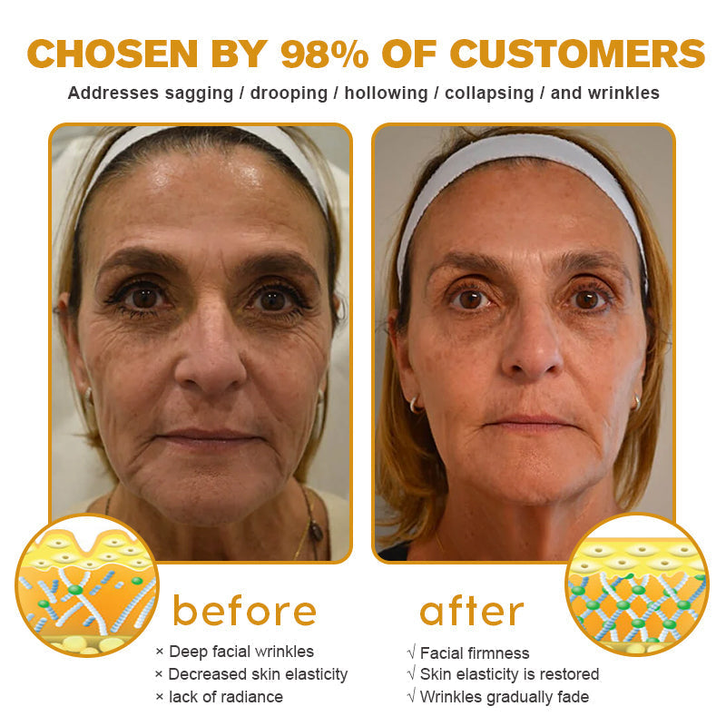 (✅🎁Made and shipped from Canada👨⚕️) Furzero™ Botox Bee Venom Wrinkle Removal Cream- LAST DAY 70% OFF